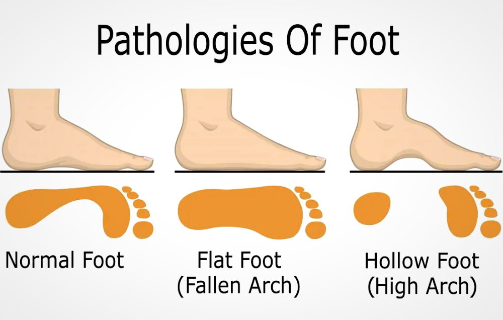 flat foot and high arch