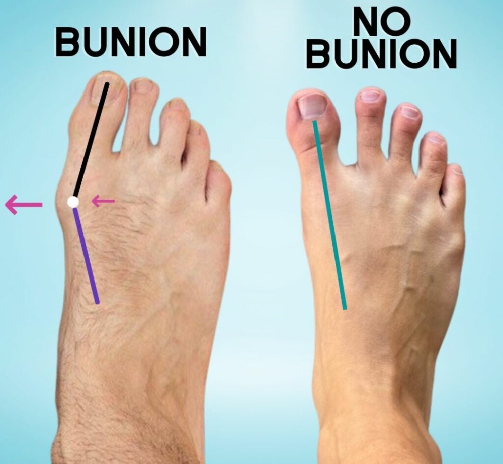 Bunions